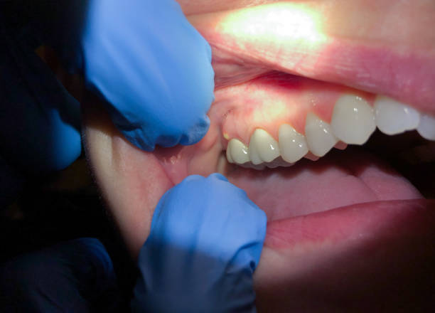 Best Emergency Tooth Extraction in Orwell, OH
